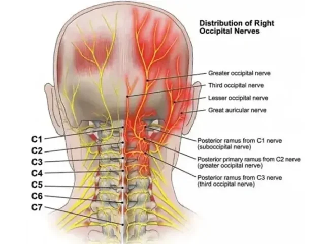 Headache Diagram