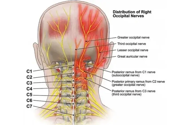 Headache Diagram
